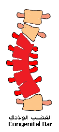 Scoliosis Scoliosis (10).gif